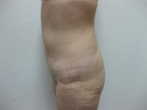 Liposuction - Patient 3 -  After 3
