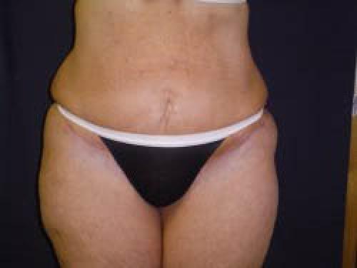 Liposuction - Patient 11 -  After 1