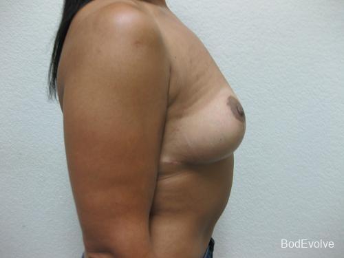 Breast Reduction - Patient 1 -  After 2