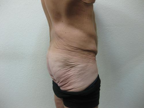 Body Lift - Patient 5 - Before 6