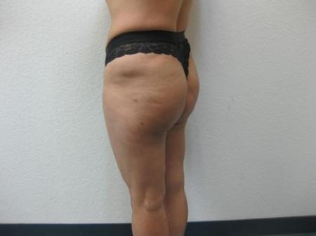 Brazilian Butt Lift - Patient 4 - After Image 3