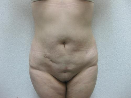 Liposuction - Patient 3 -  After 1