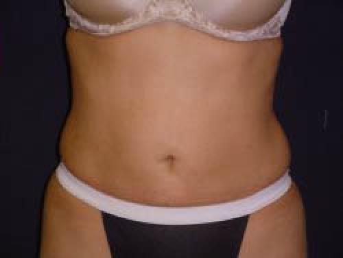 Liposuction - Patient 9 -  After 1