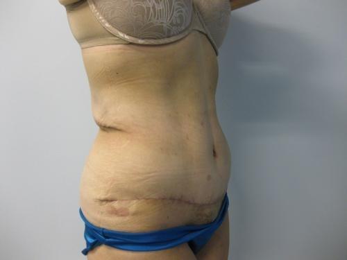 Patient 15 - Cosmetic Surgery After Massive Weight Loss -  After 4