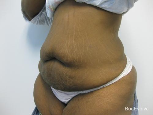 Patient 2 - Cosmetic Surgery After Massive Weight Loss - Before 2