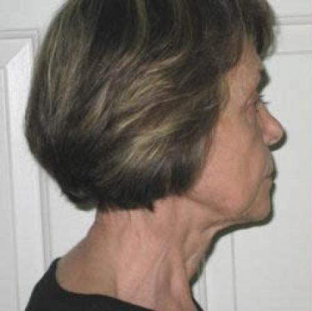 Facelift - Patient 2 - Before Image 2