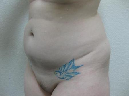 Liposuction - Patient 5 - Before Image 4