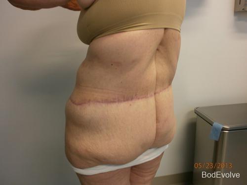 Patient 7 - Cosmetic Surgery After Massive Weight Loss -  After 4