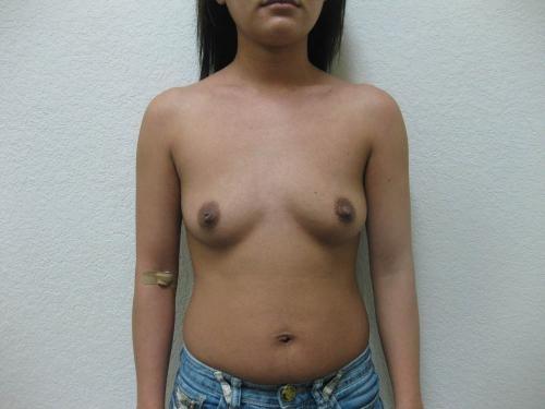 Breast Augmentation - Patient 21 - Before