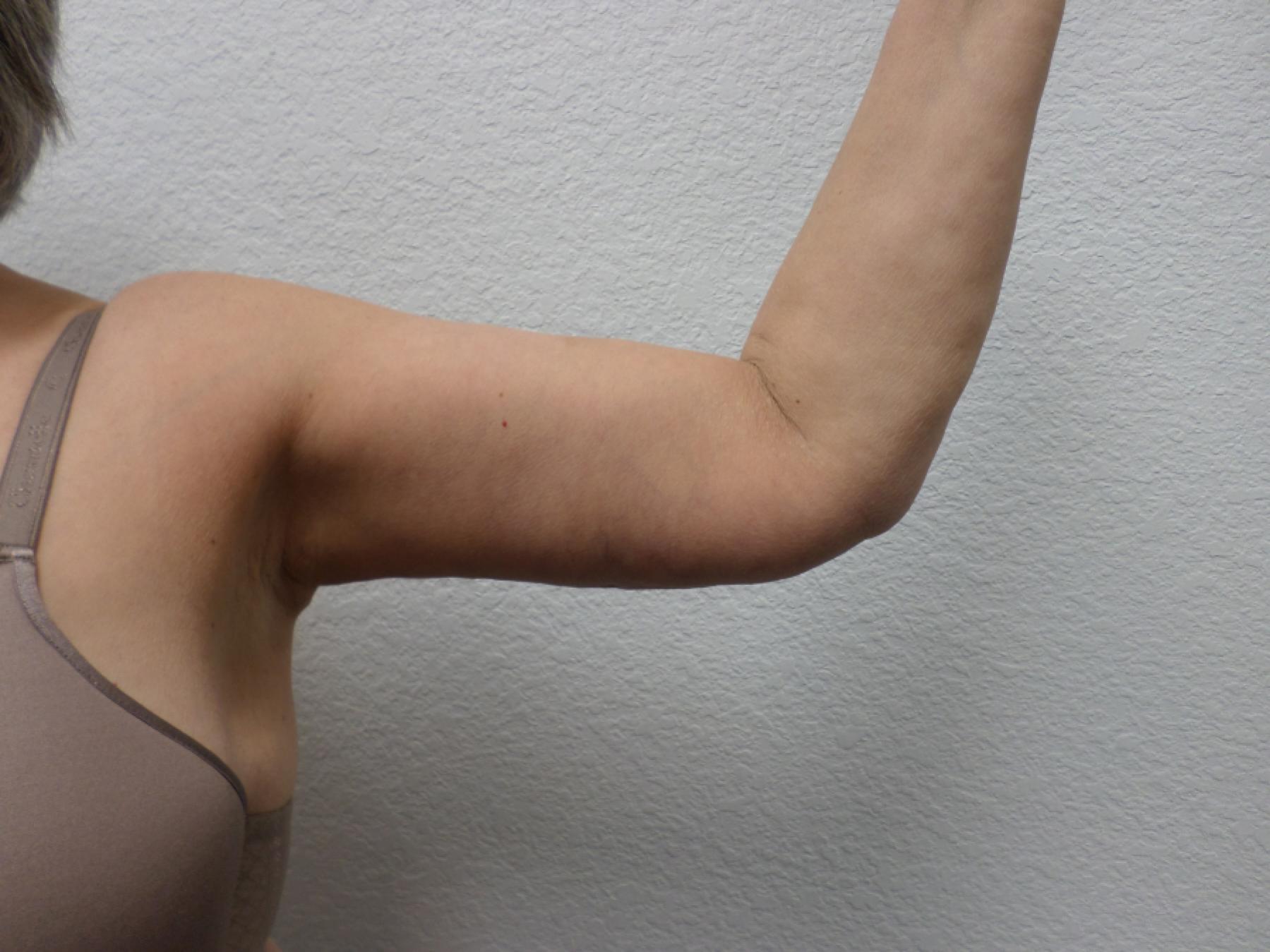 Arm Lift: Patient 5 - After  