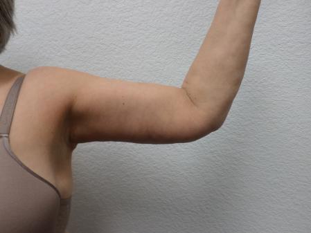 Arm Lift: Patient 4 - After 1