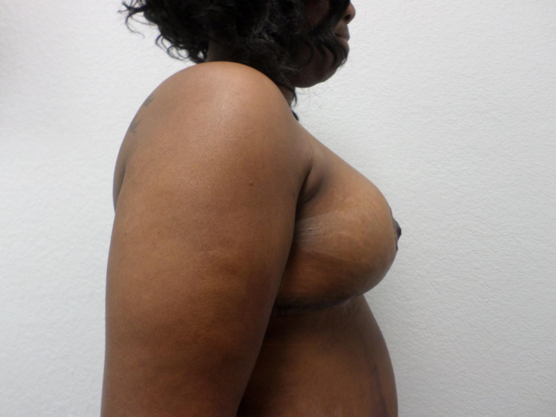 Breast Reduction: Patient 14 - After 5
