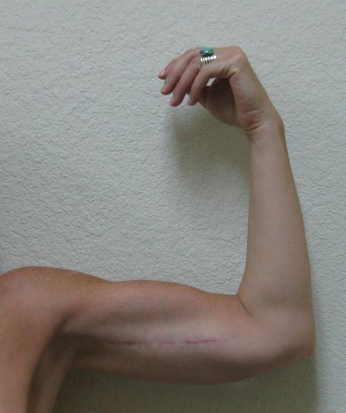 Arm Lift Surgery - Patient 3 - After 