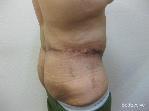 Patient 3 - Cosmetic Surgery After Massive Weight Loss -  After 6