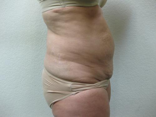 Tummy Tuck - Patient 4 - Before and After 6