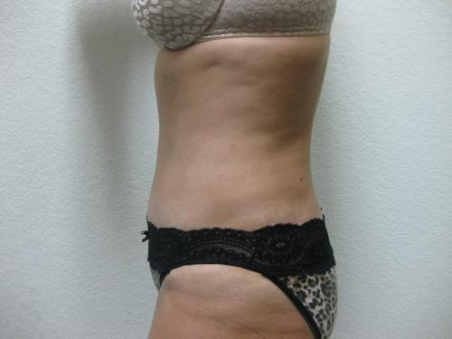 Tummy Tuck - Patient 4 -  After 4