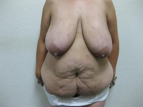 Patient 12 - Cosmetic Surgery After Massive Weight Loss - Before 1
