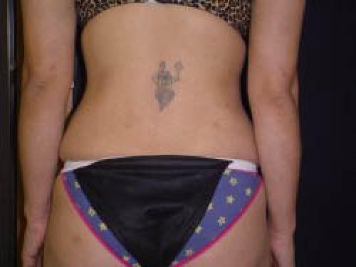 Liposuction - Patient 7 - After 