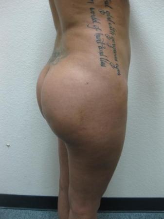 Brazilian Butt Lift - Patient 3 - After Image 6