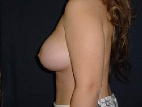 Breast Augmentation - Patient 8 -  After 3
