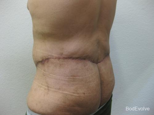 Patient 3 - Cosmetic Surgery After Massive Weight Loss -  After 4