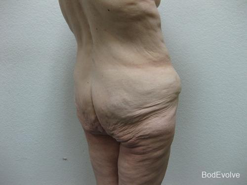 Body Lift - Patient 2 - Before 6