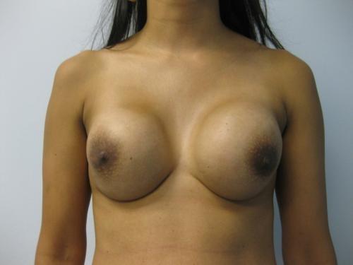 Breast Revision - Patient 2 - Before