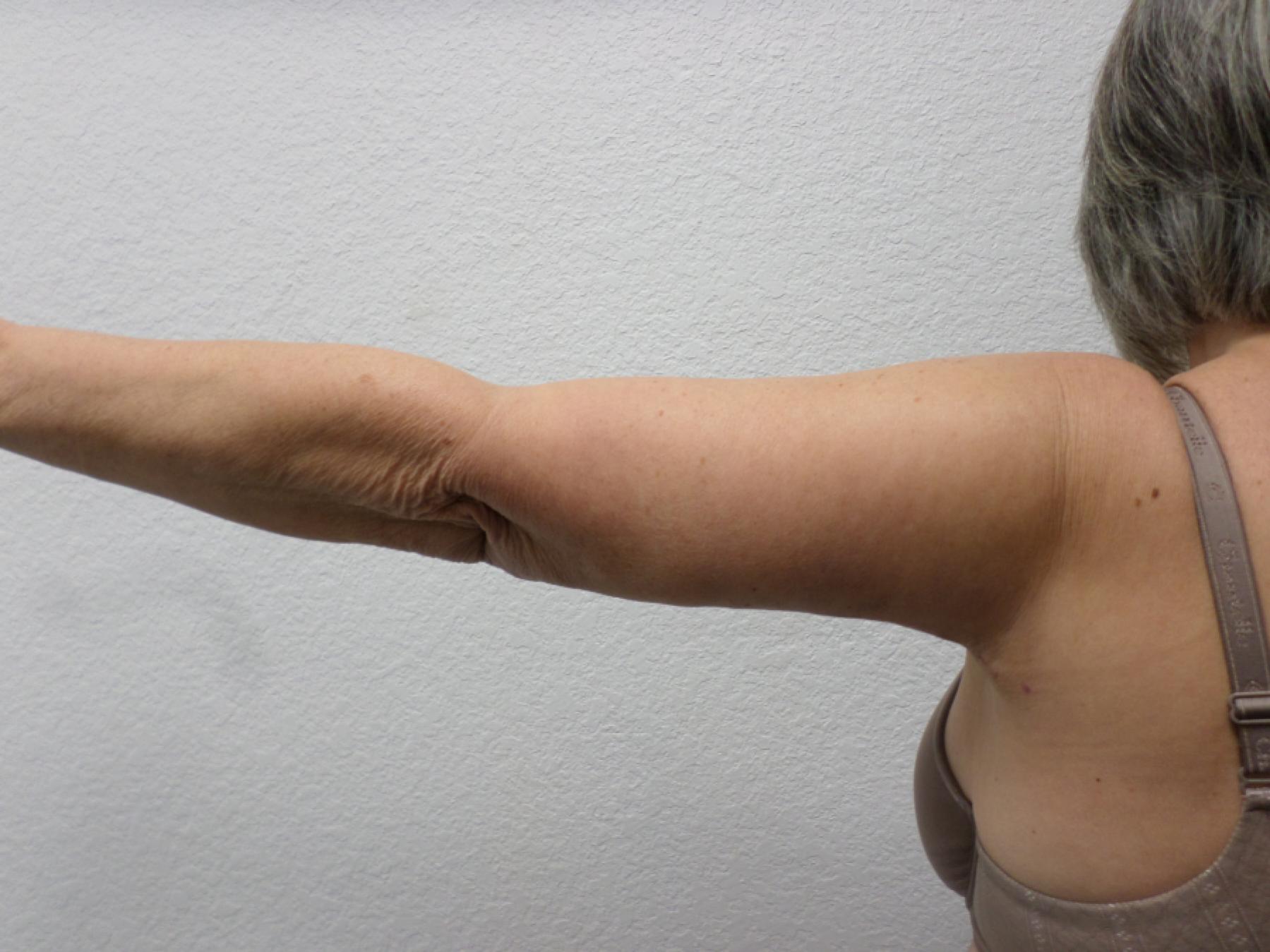 Arm Lift: Patient 9 - After 5