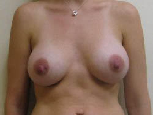 Breast Augmentation - Patient 6 - After 