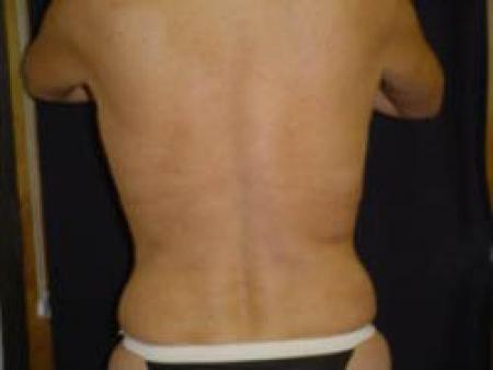 Liposuction - Patient 8 - Before Image 2