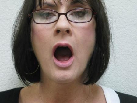 Lip Augmentation - Patient 2 - After Image 5