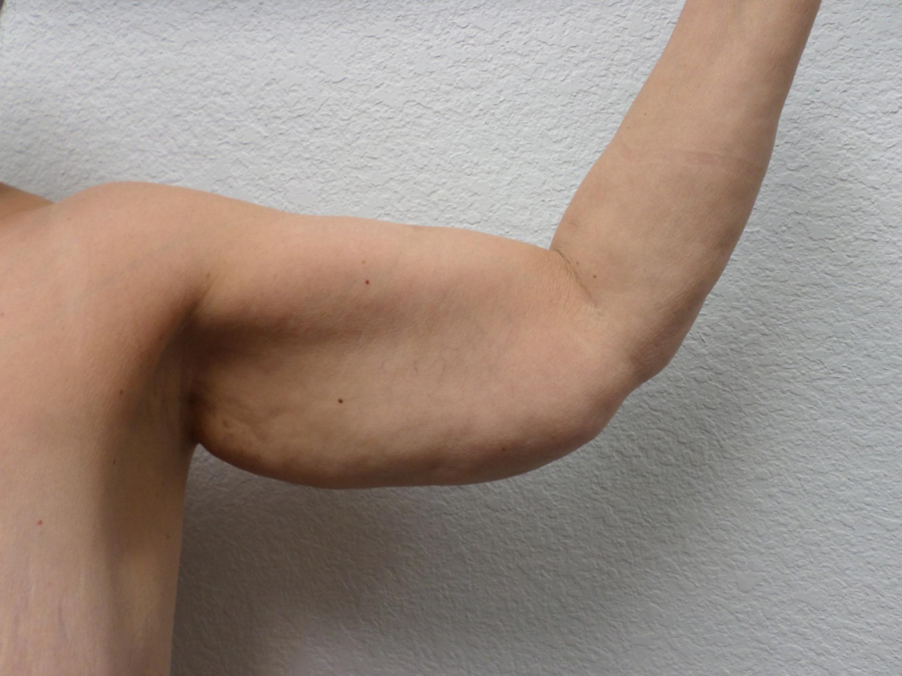 Arm Lift: Patient 5 - Before 
