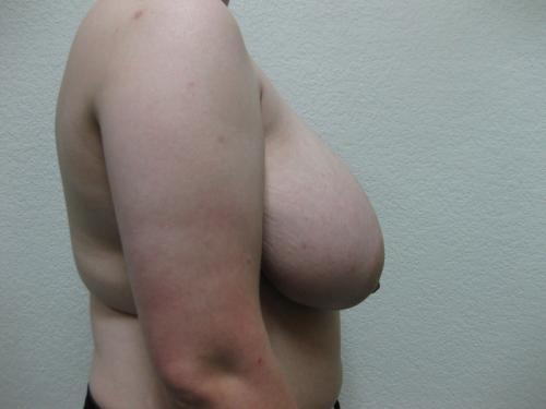 Breast Reduction - Patient 2 - Before 4