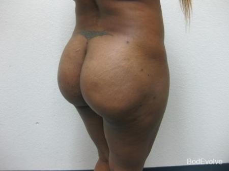 Brazilian Butt Lift - Patient 1 - After Image 2