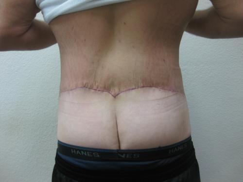Body Lift - Patient 5 - After 5