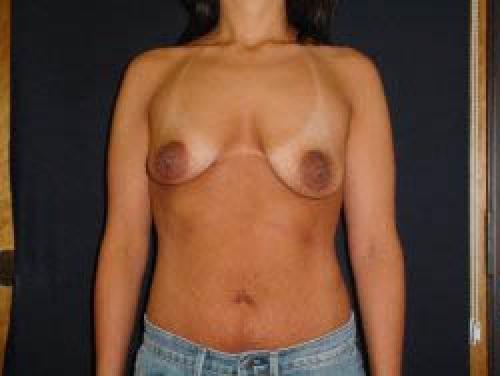 Breast Augmentation with Lift - Patient 4 - Before
