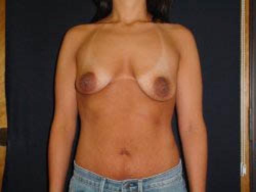 Breast Augmentation with Lift - Patient 4 - Before 1