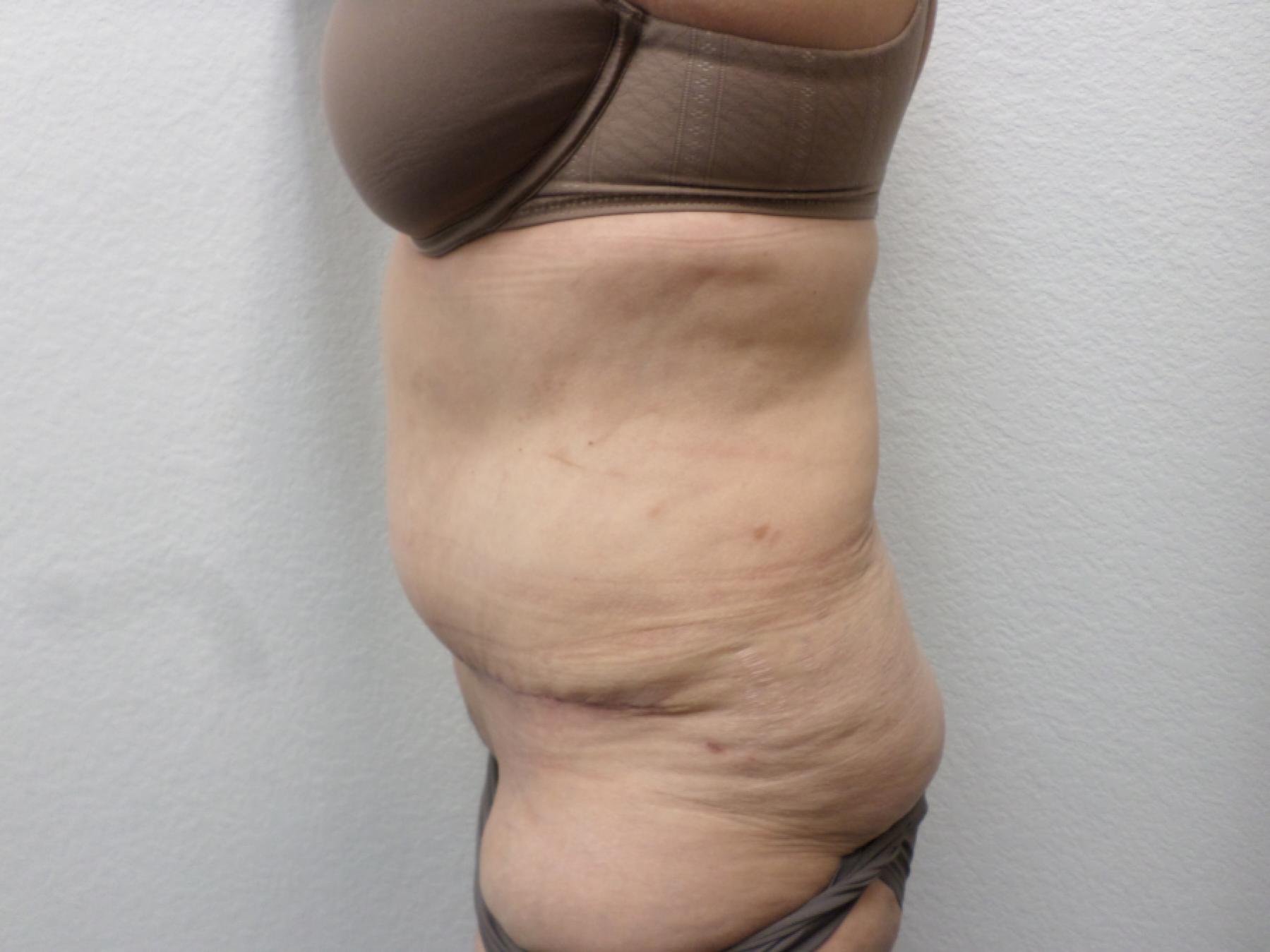 Tummy Tuck: Patient 29 - After 3
