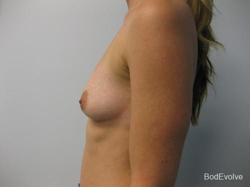 Breast Augmentation - Patient 1 - Before 3