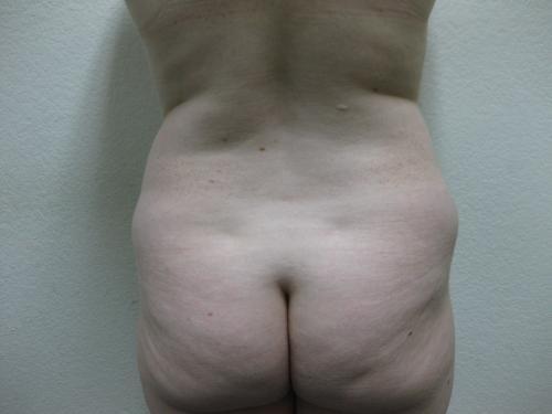 Liposuction - Patient 5 - Before 6