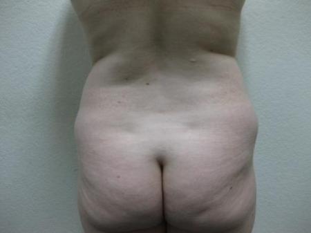 Liposuction - Patient 5 - Before Image 6