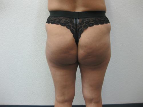 Brazilian Butt Lift - Patient 4 - After 