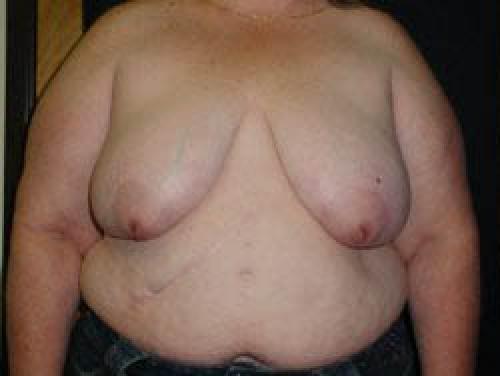 Breast Reduction - Patient 5 - Before 1