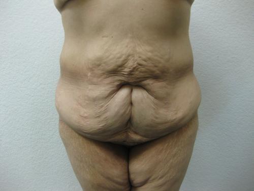 Patient 14 - Cosmetic Surgery After Massive Weight Loss - Before 1