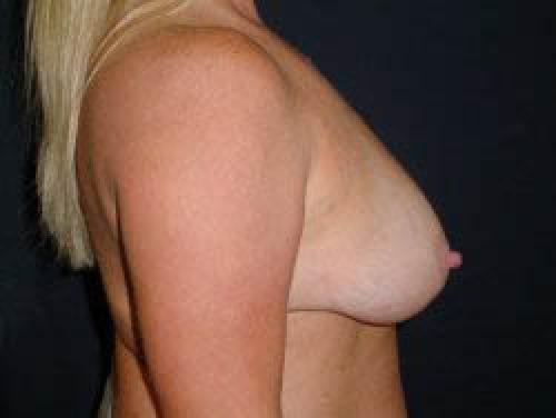 Breast Augmentation with Lift - Patient 8 - Before and After 3