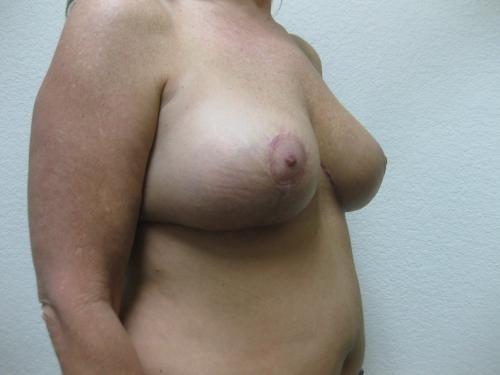 Breast Reduction - Patient 3 -  After 2
