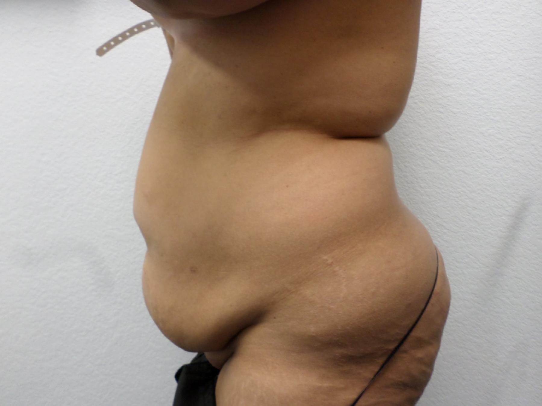 Liposuction: Patient 16 - Before 3