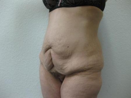 Body Lift - Patient 8 - Before Image 8