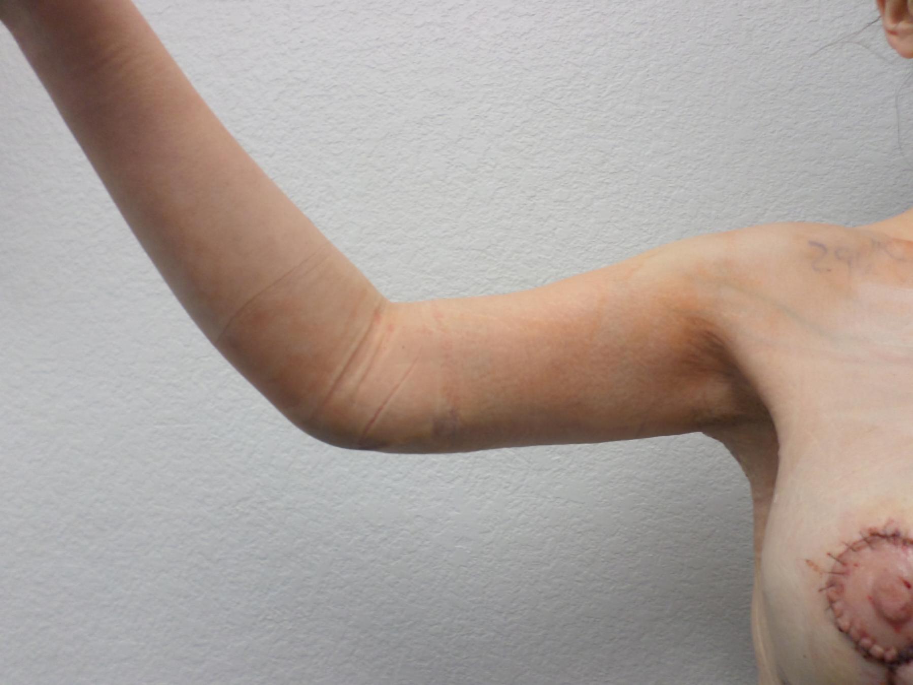 Arm Lift: Patient 8 - After 4
