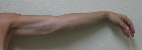 Arm Lift Surgery - Patient 3 -  After 8